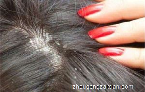 梦见自己满头上长虱子