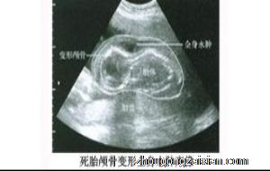 梦见自己怀孕死胎是什么意思