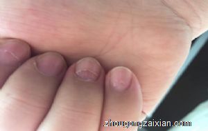 梦见手指甲盖有裂缝是什么意思