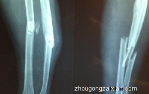 梦见自己是小腿断了是什么意思