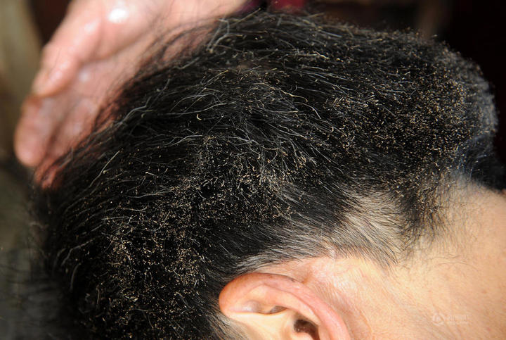 梦见孩子头发被火烧是什么意思