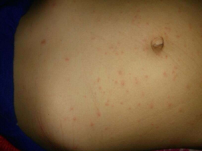 梦见肚子上起好多红疙瘩是什么意思