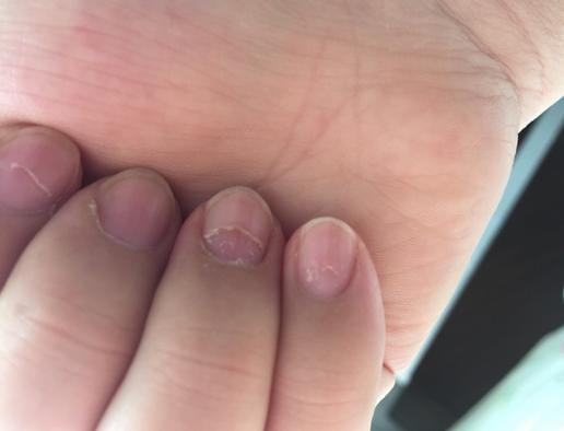 梦见手指甲盖有裂缝是什么意思