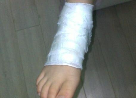 梦见自己脚脖断了是什么意思