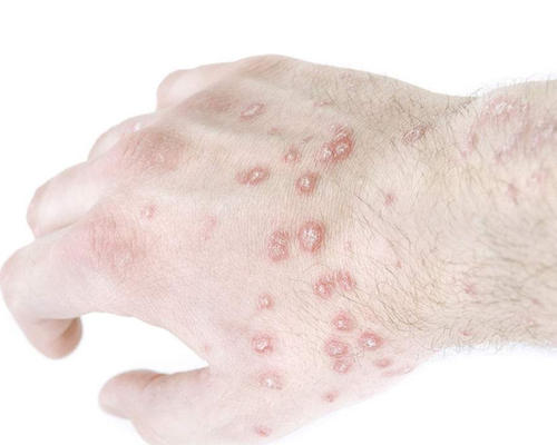 梦见得了牛皮癣是什么意思